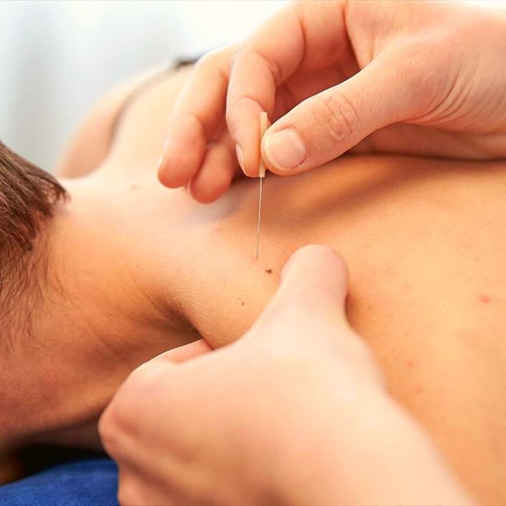 Dry needling: what is it and how can it help you?